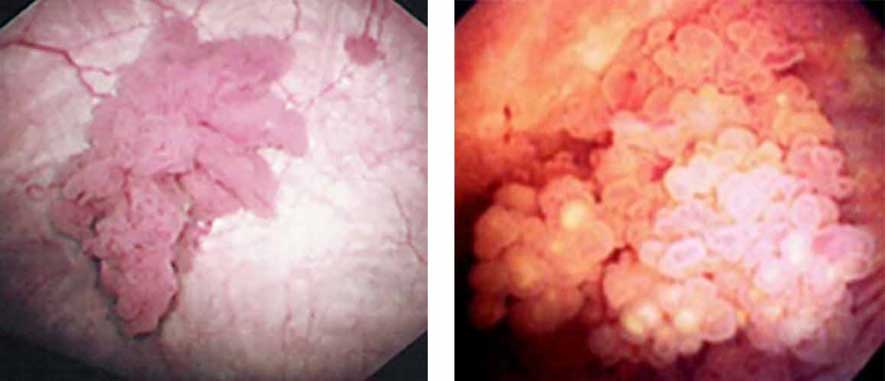 膀胱鏡（内視鏡検査）映像