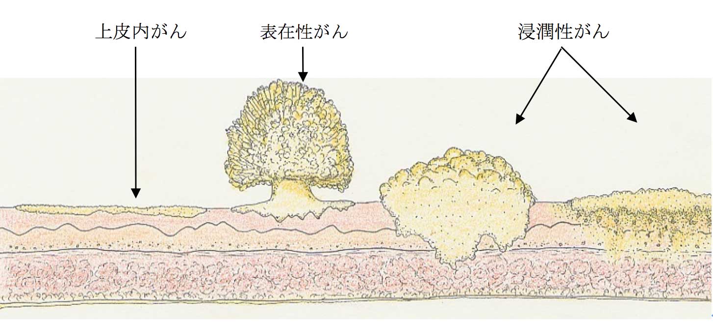 膀胱がんのタイプ