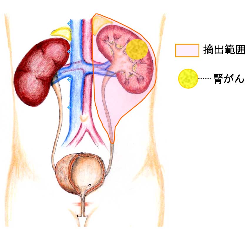 根治的腎摘除術の摘出範囲