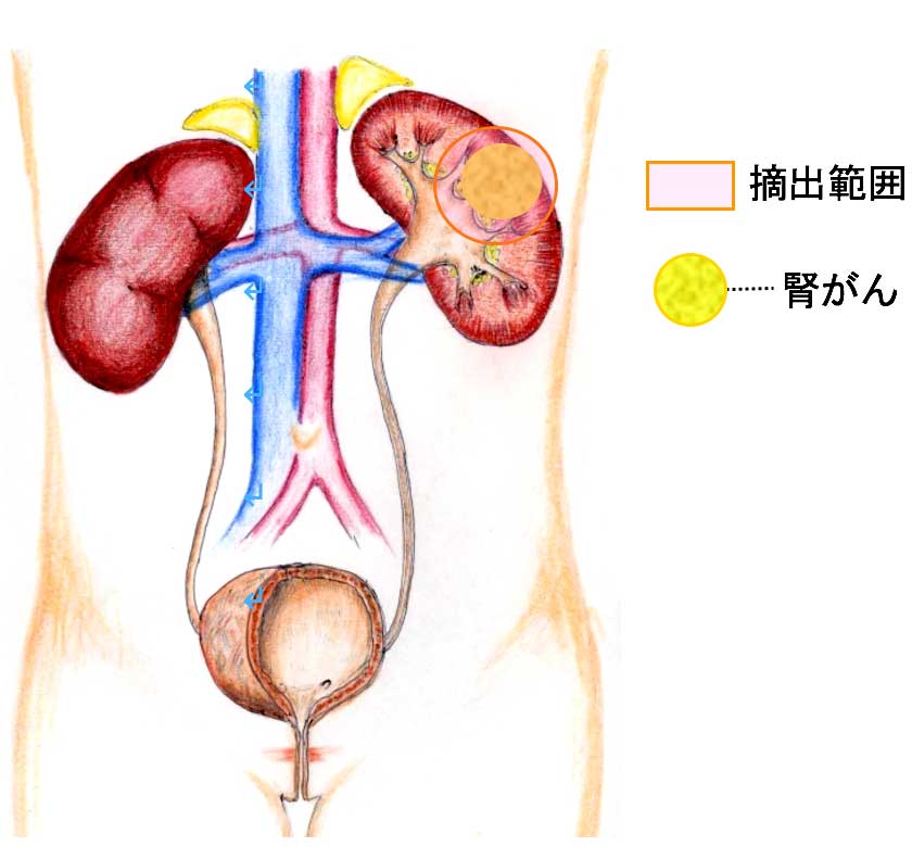 腎部分切除術の摘出範囲