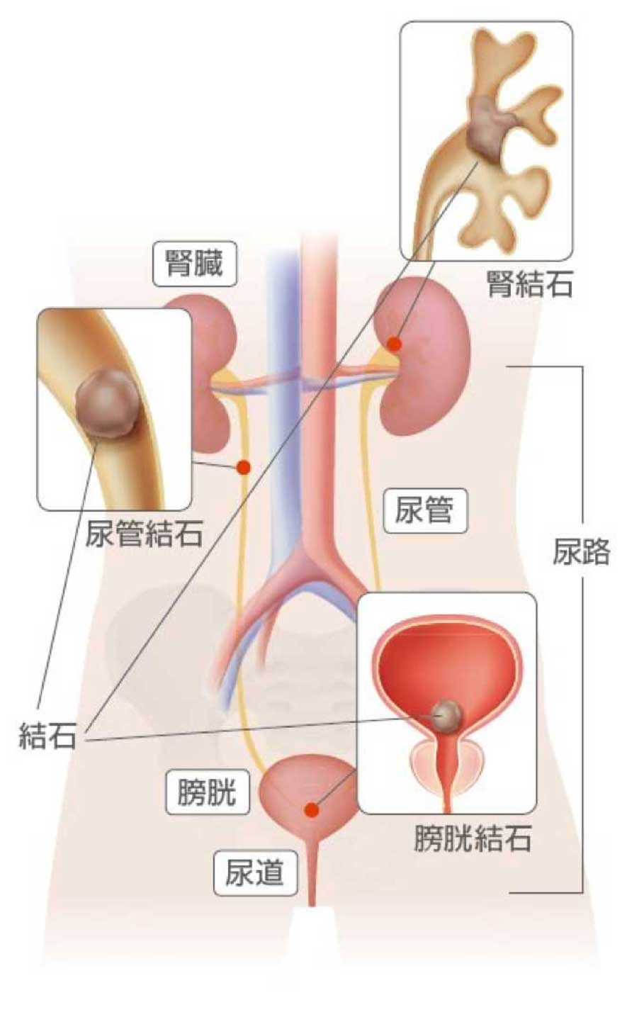 腎・尿路結石の発生場所