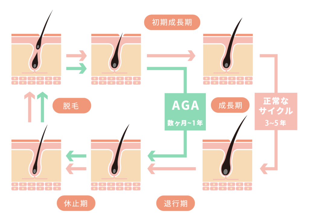 AGA(男性型脱毛症)の生え替わりサイクル