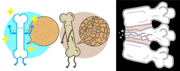骨密度の低下による骨折