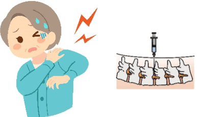 神経ブロック治療